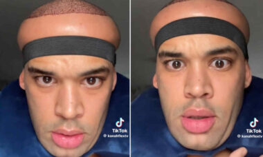 Tiktoker mostra cabeça inchada após fazer transplante capilar e vídeo viraliza