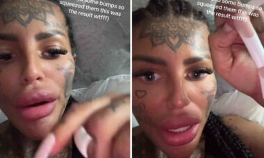 Vídeo: Influencer choca seguidores após mostrar que seu preenchimento labial começou a "vazar"
