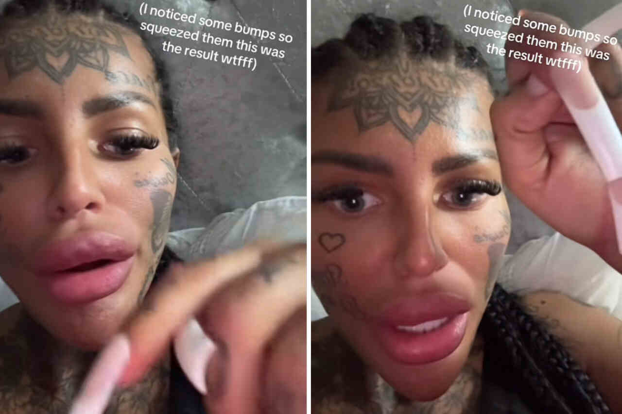 Vídeo: Influencer choca seguidores após mostrar que seu preenchimento labial começou a "vazar"