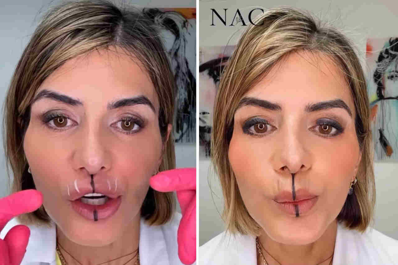 Médica aplica preenchimento em apenas um lado dos lábios para mostrar diferença após duas semanas