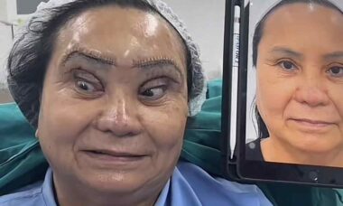 Mulher passa por procedimento chamado "olhos de cisne negro" e deixa internautas horrorizados