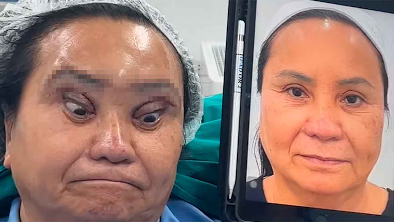 Mulher passa por procedimento chamado "olhos de cisne negro" e deixa internautas horrorizados (Foto: TikTok)