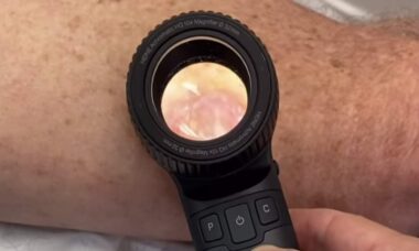 Vídeo: Médico faz alerta de "pior" tipo de câncer de pele que ele já viu