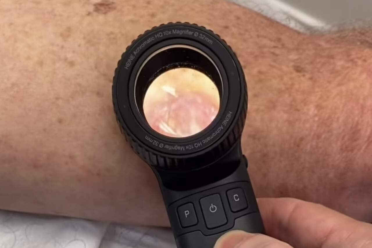 Vídeo: Médico faz alerta de "pior" tipo de câncer de pele que ele já viu