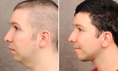 Youtuber Nikocado Avocado mostra resultado de cirurgia plástica após perder mais de 100kg